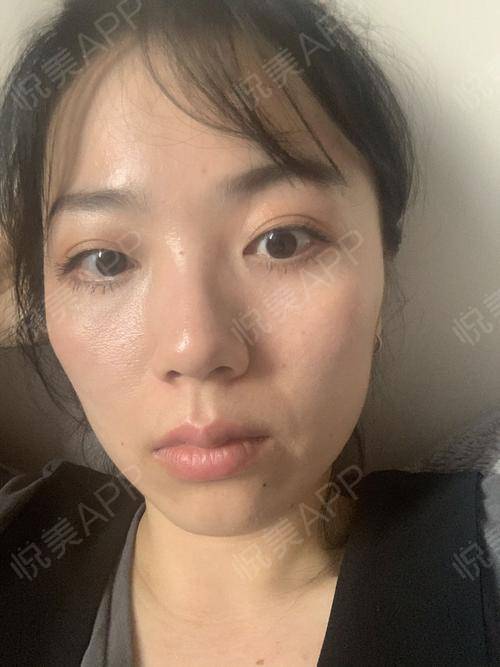感觉还是中午的状态和效果是最好的,早上会稍微的肿一...双眼皮 悦美整形